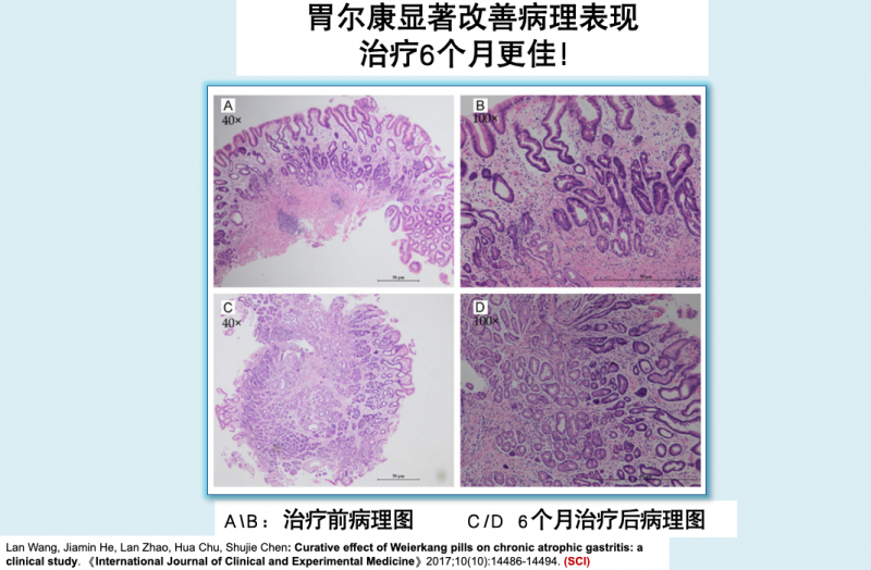 胃尔康片：不仅缓解症状，更能显著改善病理状态